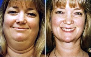 jowl facial exercises Mens creampie asshole thumbnail gallery